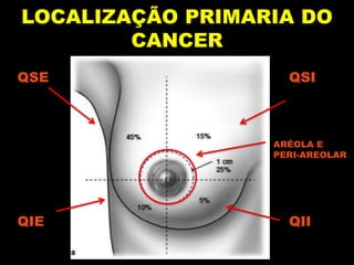 LOCALIZAÇÃO PRIMARIA DO
CANCER
QSE QSI
QIE QII
ARÉOLA E
PERI-AREOLAR
 