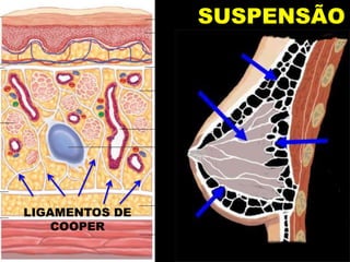 ELEMENTOS DE SUSPENSÃOFOLHA ANTERIOR
FOLHA POSTERIOR
FASCIA DO PEITORAL
MAIOR
LIGAMENTOS DE
COOPER
 