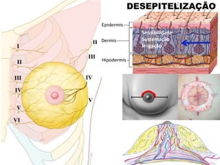 DESEPITELIZAÇÃO
- Sensibilidade
- Sustentação
- Irrigação
 