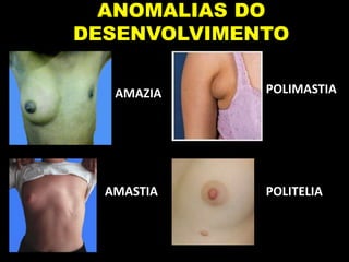 ANOMALIAS DO
DESENVOLVIMENTO
AMAZIA
AMASTIA
POLIMASTIA
POLITELIA
 