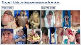Etapas iniciais do desenvolvimento embrionário.
12
Espinha bífida
 