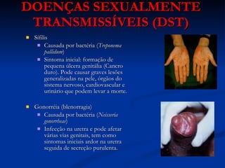 DOENÇAS SEXUALMENTE TRANSMISSÍVEIS (DST) Sífilis Causada por bactéria ( Treponema pallidum ) Sintoma inicial: formação de pequena úlcera genitália (Cancro duro). Pode causar graves lesões generalizadas na pele, órgãos do sistema nervoso, cardiovascular e urinário que podem levar a morte. Gonorréia (blenorragia) Causada por bactéria ( Neisseria gonorrheae ) Infecção na uretra e pode afetar várias vias genitais, tem como sintomas iniciais ardor na uretra seguida de secreção purulenta. 