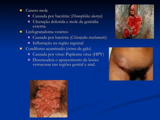 Cancro mole Causada por bactéria: ( Hemophilus ducreyi ) Ulceração dolorida e mole da genitália externa. Linfogranuloma venéreo Causada por bactéria ( Chlamydia trachomatis ) Inflamação na região inguinal Condiloma acuminado (crista de galo) Causada por vírus: Papiloma virus (HPV) Desencadeia o aparecimento de lesões verrucosas nas regiões genital e anal. 