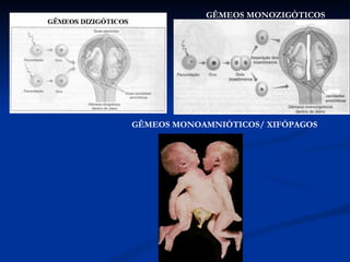 GÊMEOS MONOZIGÓTICOS GÊMEOS MONOAMNIÓTICOS/ XIFÓPAGOS 
