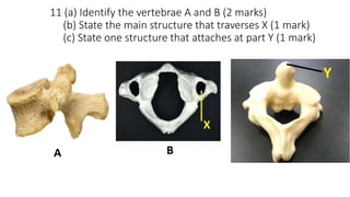 11 (a) Identify the vertebrae A and B (2 marks)
(b) State the main structure that traverses X (1 mark)
(c) State one structure that attaches at part Y (1 mark)
 