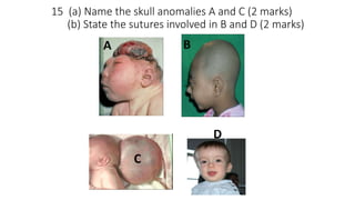 15 (a) Name the skull anomalies A and C (2 marks)
(b) State the sutures involved in B and D (2 marks)
 