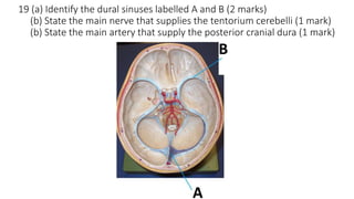 19 (a) Identify the dural sinuses labelled A and B (2 marks)
(b) State the main nerve that supplies the tentorium cerebelli (1 mark)
(b) State the main artery that supply the posterior cranial dura (1 mark)
 