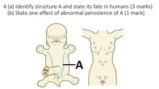 4 (a) Identify structure A and state its fate in humans (3 marks)
(b) State one effect of abnormal persistence of A (1 mark)
 