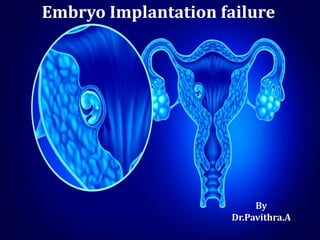 Embryo Implantation failure
By
Dr.Pavithra.A
 