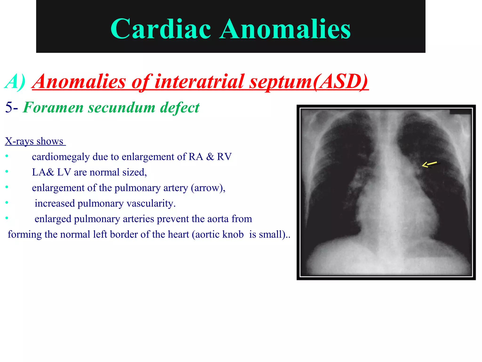 Cardiac Anomalies
A) Anomalies of interatrial septum(ASD)
5- Foramen secundum defect
X-rays shows
• cardiomegaly due to enlargement of RA & RV
• LA& LV are normal sized,
• enlargement of the pulmonary artery (arrow),
• increased pulmonary vascularity.
• enlarged pulmonary arteries prevent the aorta from
forming the normal left border of the heart (aortic knob is small)..
 