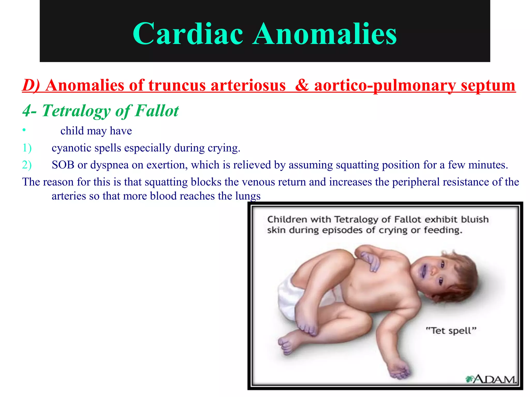 Cardiac Anomalies
D) Anomalies of truncus arteriosus & aortico-pulmonary septum
4- Tetralogy of Fallot
• child may have
1) cyanotic spells especially during crying.
2) SOB or dyspnea on exertion, which is relieved by assuming squatting position for a few minutes.
The reason for this is that squatting blocks the venous return and increases the peripheral resistance of the
arteries so that more blood reaches the lungs
 