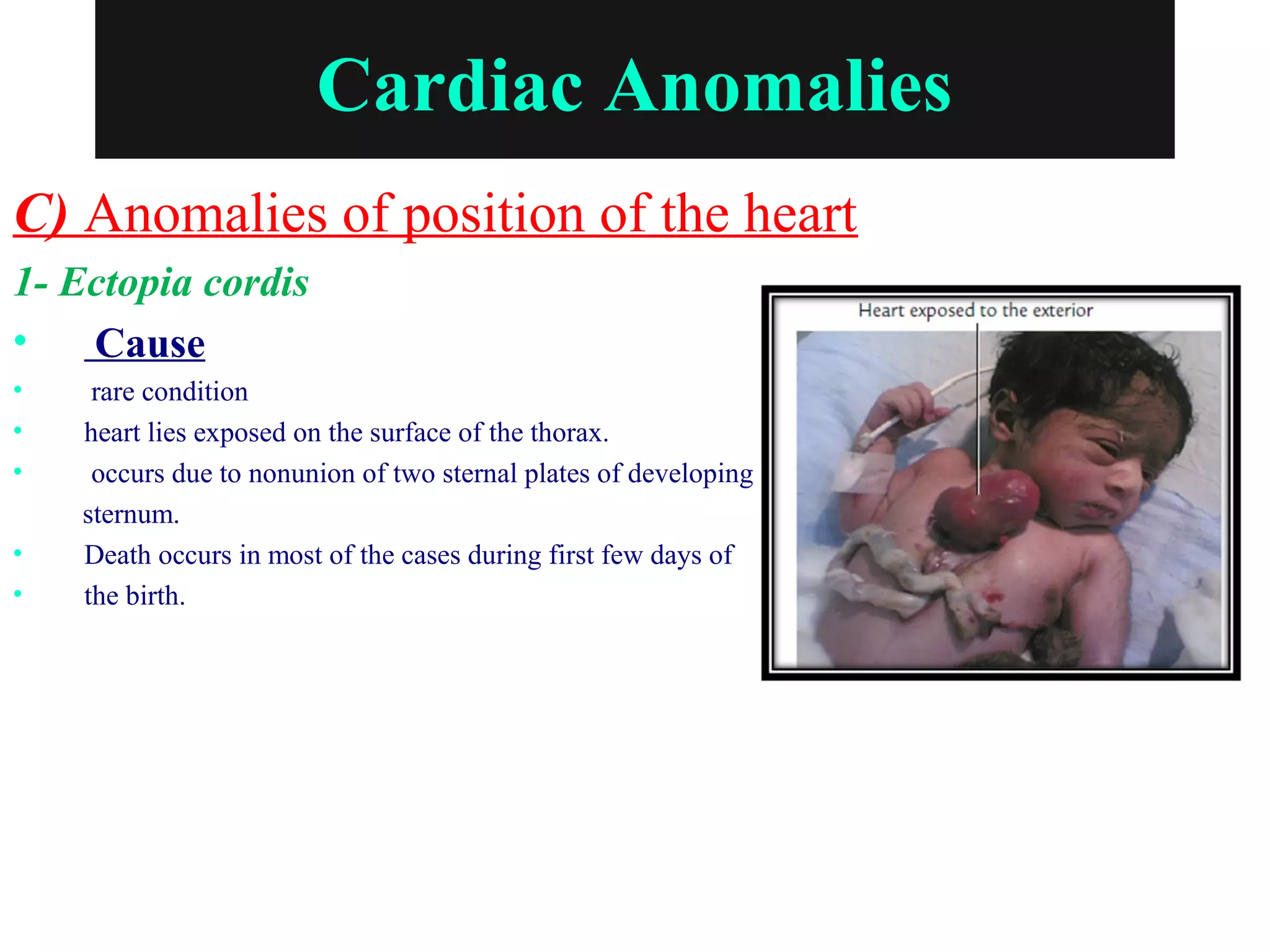Cardiac Anomalies
C) Anomalies of position of the heart
1- Ectopia cordis
• Cause
• rare condition
• heart lies exposed on the surface of the thorax.
• occurs due to nonunion of two sternal plates of developing
sternum.
• Death occurs in most of the cases during first few days of
• the birth.
 