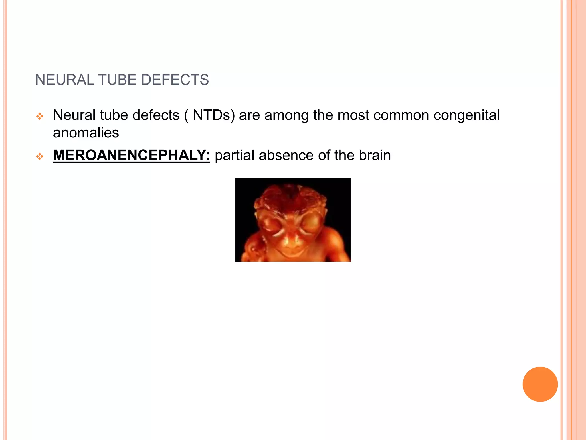 NEURAL TUBE DEFECTS
 Neural tube defects ( NTDs) are among the most common congenital
anomalies
 MEROANENCEPHALY: partial absence of the brain
 