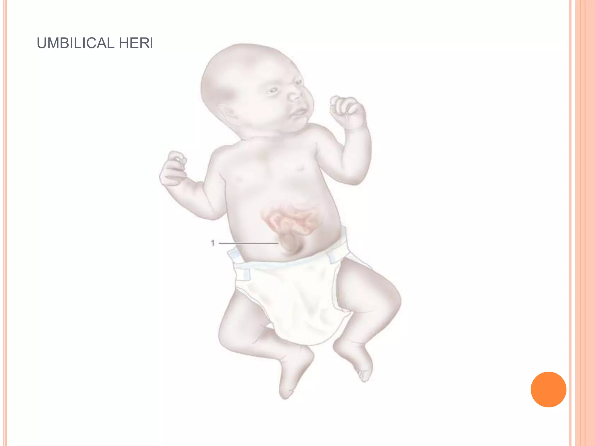 UMBILICAL HERNIATION
 