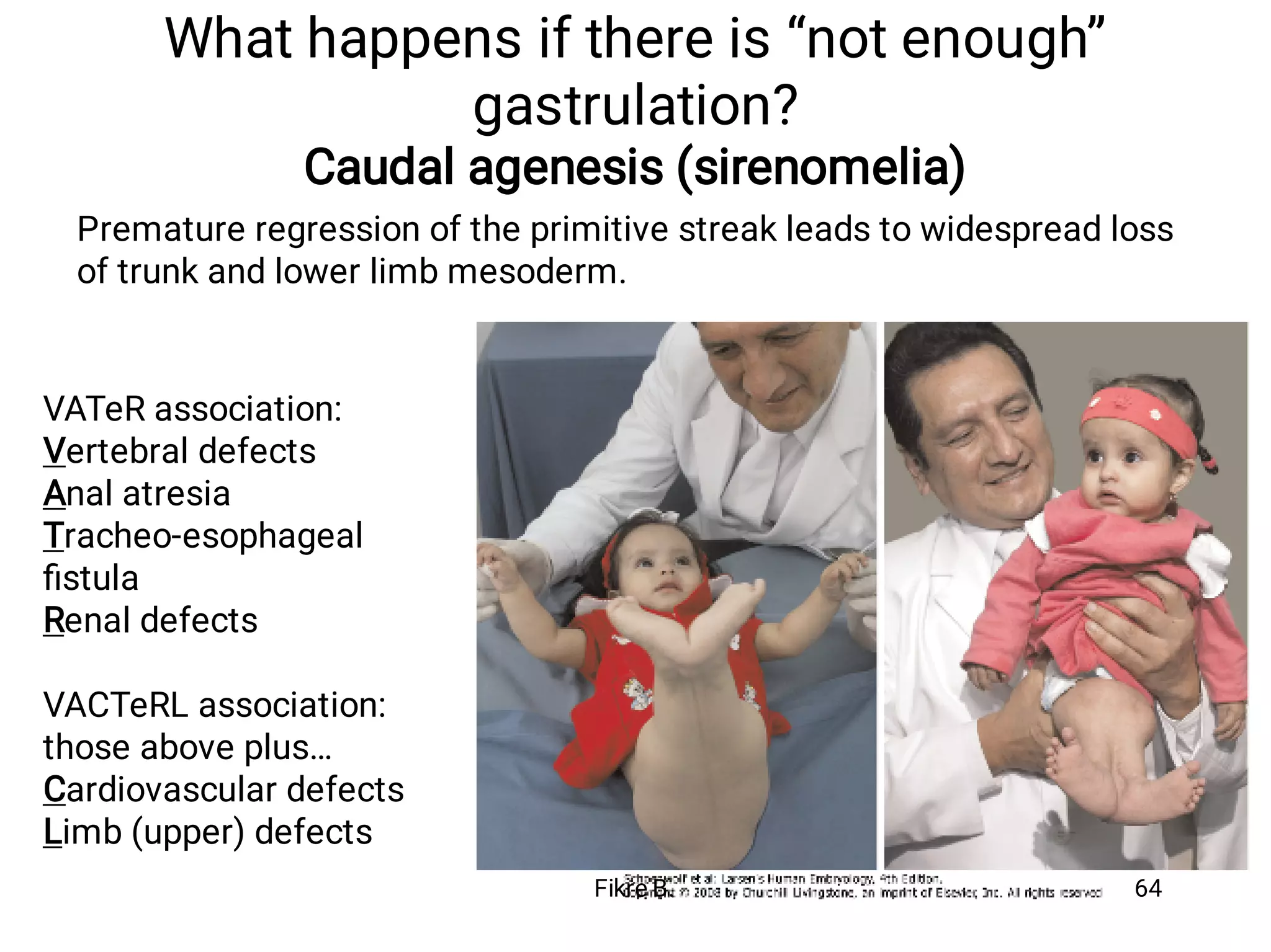 What happens if there is “not enough”
gastrulation?
Caudal agenesis (sirenomelia)
Premature regression of the primitive streak leads to widespread loss
of trunk and lower limb mesoderm.
VATeR association:
Vertebral defects
Anal atresia
Tracheo-esophageal
ﬁstula
Renal defects
VACTeRL association:
those above plus…
Cardiovascular defects
Limb (upper) defects
Fikre B. 64
 
