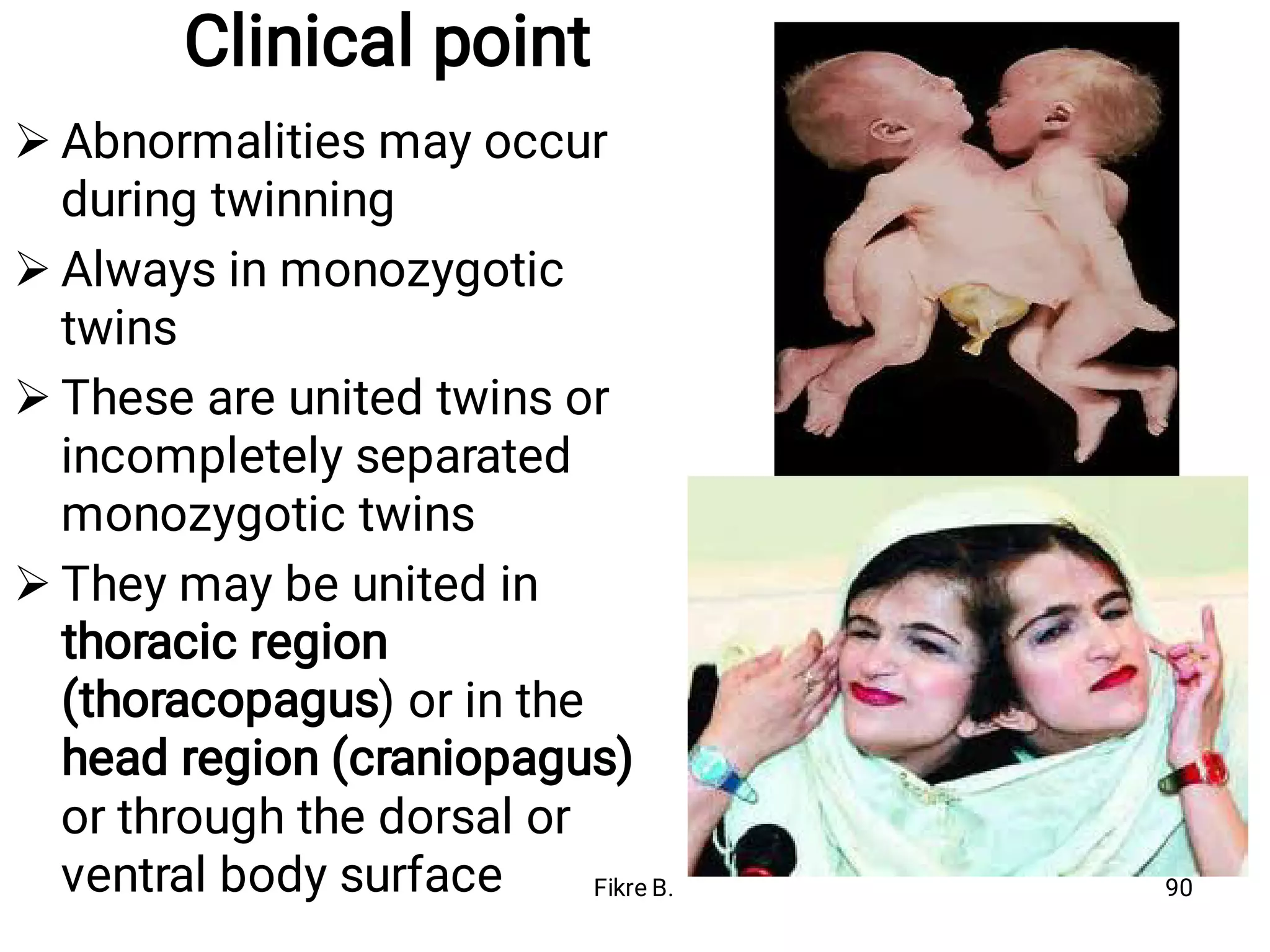 Clinical point




Abnormalities may occur
during twinning
Always in monozygotic
twins
These are united twins or
incompletely separated
monozygotic twins
They may be united in
thoracic region
(thoracopagus) or in the
head region (craniopagus)
or through the dorsal or
ventral body surface Fikre B. 90
 