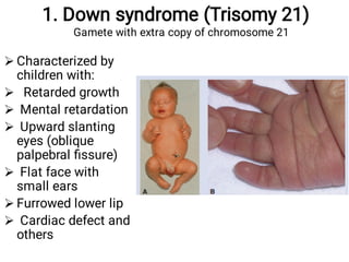 1. Down syndrome (Trisomy 21)
Gamete with extra copy of chromosome 21







Characterized by
children with:
Retarded growth
Mental retardation
Upward slanting
eyes (oblique
palpebral ﬁssure)
Flat face with
small ears
Furrowed lower lip
Cardiac defect and
others
 