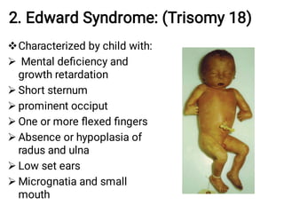 2. Edward Syndrome: (Trisomy 18)








Characterized by child with:
Mental deﬁciency and
growth retardation
Short sternum
prominent occiput
One or more ﬂexed ﬁngers
Absence or hypoplasia of
radus and ulna
Low set ears
Micrognatia and small
mouth
 