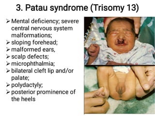 3. Patau syndrome (Trisomy 13)








Mental deﬁciency; severe
central nervous system
malformations;
sloping forehead;
malformed ears,
scalp defects;
microphthalmia;
bilateral cleft lip and/or
palate;
polydactyly;
posterior prominence of
the heels
 