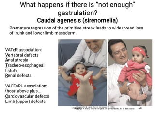 What happens if there is “not enough”
gastrulation?
Caudal agenesis (sirenomelia)
Premature regression of the primitive streak leads to widespread loss
of trunk and lower limb mesoderm.
VATeR association:
Vertebral defects
Anal atresia
Tracheo-esophageal
ﬁstula
Renal defects
VACTeRL association:
those above plus…
Cardiovascular defects
Limb (upper) defects
Fikre B. 64
 