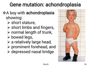Gene mutation: achondroplasia








A boy with achondroplasia
showing:
short stature,
short limbs and ﬁngers,
normal length of trunk,
bowed legs,
a relatively large head,
prominent forehead, and
depressed nasal bridge
Fikre B. 95
 
