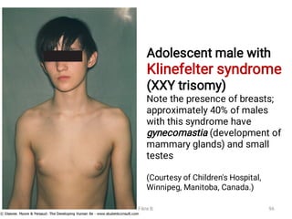 Adolescent male with
Klinefelter syndrome
(XXY trisomy)
Note the presence of breasts;
approximately 40% of males
with this syndrome have
gynecomastia (development of
mammary glands) and small
testes
(Courtesy of Children's Hospital,
Winnipeg, Manitoba, Canada.)
Fikre B. 96
 