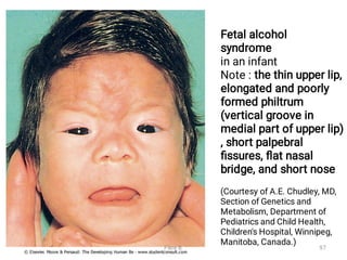 Fetal alcohol
syndrome
in an infant
Note : the thin upper lip,
elongated and poorly
formed philtrum
(vertical groove in
medial part of upper lip)
, short palpebral
ﬁssures, ﬂat nasal
bridge, and short nose
(Courtesy of A.E. Chudley, MD,
Section of Genetics and
Metabolism, Department of
Pediatrics and Child Health,
Children's Hospital, Winnipeg,
Manitoba, Canada.)
Fikre B. 97
 