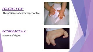 POLYDACTYLY:
The presence of extra finger or toe
ECTRODACTYLY:
Absence of digits
 