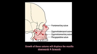 Growth of these sutures will displace the maxilla
downwards & forwards
 