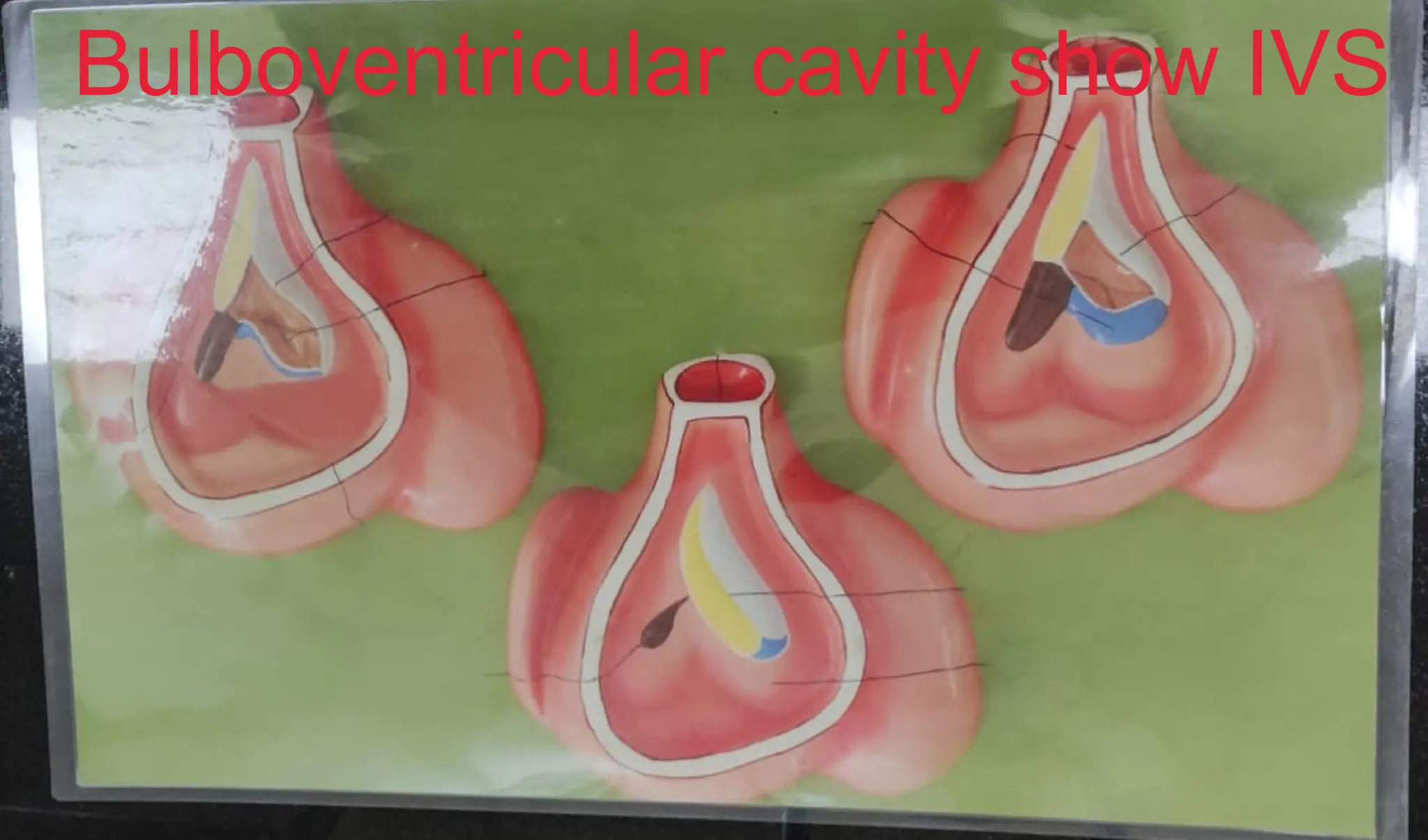 Bulboventricular cavity show IVS
 