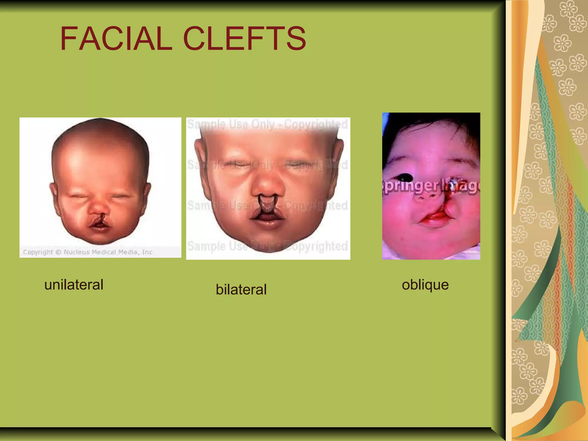 FACIAL CLEFTS
unilateral bilateral oblique
 