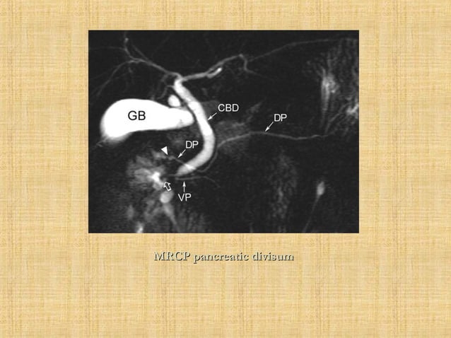 Embryology of pancreas and Imaging of pancreatitis | PPT