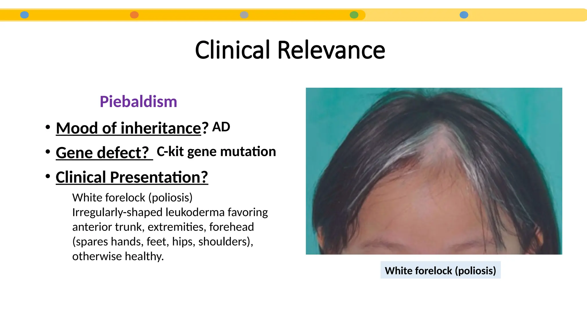 Clinical Relevance
• Mood of inheritance?
• Gene defect?
• Clinical Presentation?
White forelock (poliosis)
AD
C-kit gene mutation
White forelock (poliosis)
Irregularly-shaped leukoderma favoring
anterior trunk, extremities, forehead
(spares hands, feet, hips, shoulders),
otherwise healthy.
Piebaldism
 