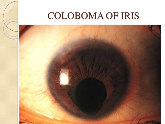 aniridia a panocular developmental malformation essay Malformations of cortical development (mcd) result from disruptions in the complex process of the human brain cortex formation and are highly associated to. aniridia a panocular developmental malformation essay Malformations of cortical development (mcd) result from disruptions in the complex process of the human brain cortex formation and are highly associated to.