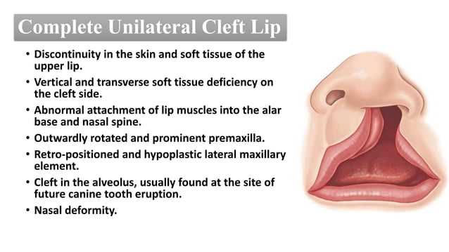 Embryology & Surgical Anatomy of Cleft Lip.pptx | Pregnancy ...
