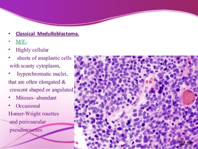 42+ Homer Wright Rosettes Seen In Medulloblastoma Background