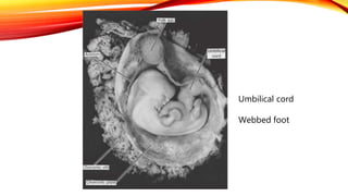 Umbilical cord
Webbed foot
 