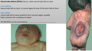 Neural tube defects (NTDs): Occurs when neural tube fails to close
Anencephaly:
Neural tube fails to close in cranial region & most of the brain fails to form.
Spina bifida:
neural tube fail to close anywhere form cervical region caudally.
Most common site: Lumbosacral region
50-70% NTDs can be prevented by……………………………………………………….
 