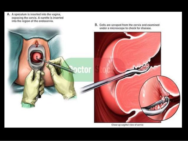 embryo transfer