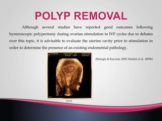 Although several studies have reported good outcomes following
hysteroscopic polypectomy during ovarian stimulation in IVF cycles due to debates
over this topic, it is advisable to evaluate the uterine cavity prior to stimulation in
order to determine the presence of an existing endometrial pathology.
(Batioglu & Kaymak, 2005; Madani et al., 2009b)
?????
 