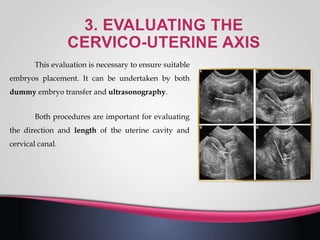 This evaluation is necessary to ensure suitable
embryos placement. It can be undertaken by both
dummy embryo transfer and ultrasonography.
Both procedures are important for evaluating
the direction and length of the uterine cavity and
cervical canal.
 