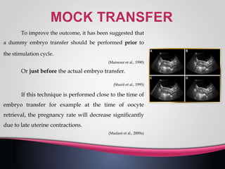 To improve the outcome, it has been suggested that
a dummy embryo transfer should be performed prior to
the stimulation cycle.
(Mansour et al., 1990)
Or just before the actual embryo transfer.
(Sharif et al., 1995)
If this technique is performed close to the time of
embryo transfer for example at the time of oocyte
retrieval, the pregnancy rate will decrease significantly
due to late uterine contractions.
(Madani et al., 2009a)
 