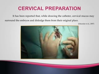 It has been reported that, while drawing the catheter, cervical mucus may
surround the embryos and dislodge them from their original place.
(Eskandar et al., 2007)
 