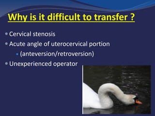 Why is it difficult to transfer ?
 Cervical stenosis
 Acute angle of uterocervical portion
 (anteversion/retroversion)
 Unexperienced operator
 
