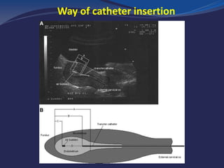Way of catheter insertion
 