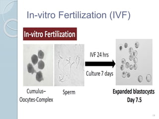 In-vitro Fertilization (IVF)
18
 
