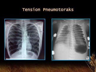 Tension Pneumotoraks
 