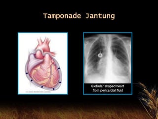 Tamponade Jantung
 