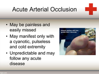 Acute Arterial Occlusion 
• May be painless and 
easily missed 
• May manifest only with 
a cyanotic, pulseless 
and cold extremity 
• Unpredictable and may 
follow any acute 
disease 
 