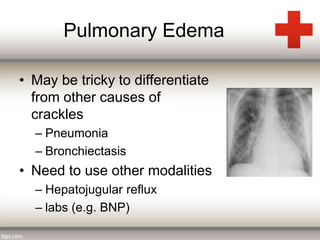 Pulmonary Edema 
• May be tricky to differentiate 
from other causes of 
crackles 
– Pneumonia 
– Bronchiectasis 
• Need to use other modalities 
– Hepatojugular reflux 
– labs (e.g. BNP) 
 